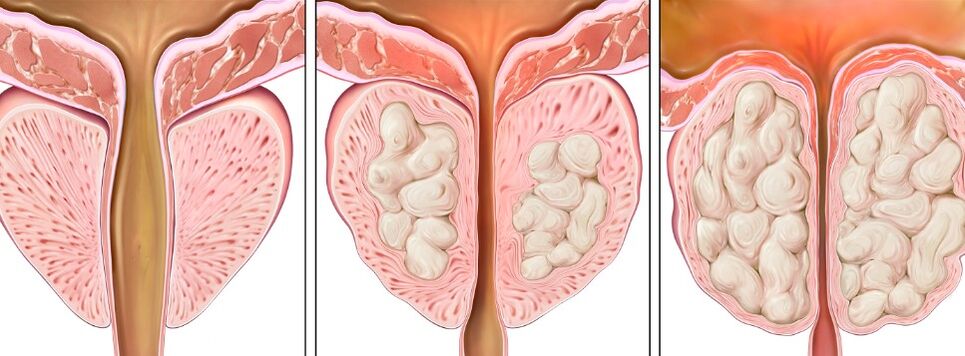 Prostatitis phases