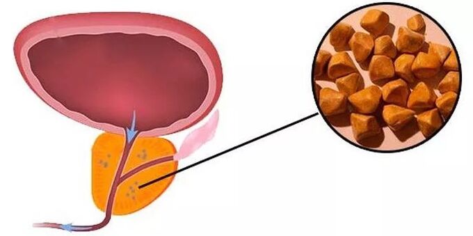 Stones prostate