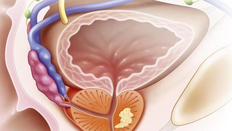 Chronic prostatitis