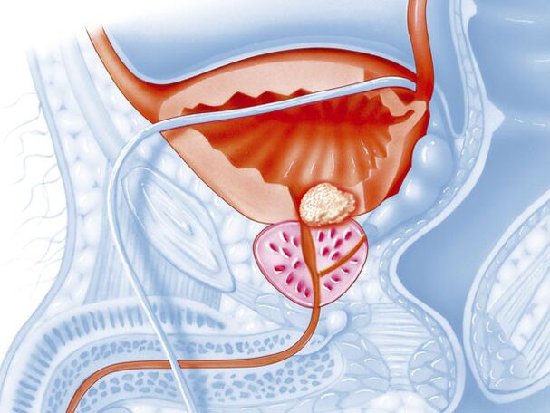 The bacterial form of prostatitis